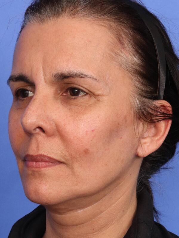 Laser Skin Resurfacing Before & After Image