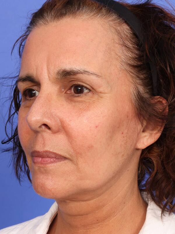 Laser Skin Resurfacing Before & After Image