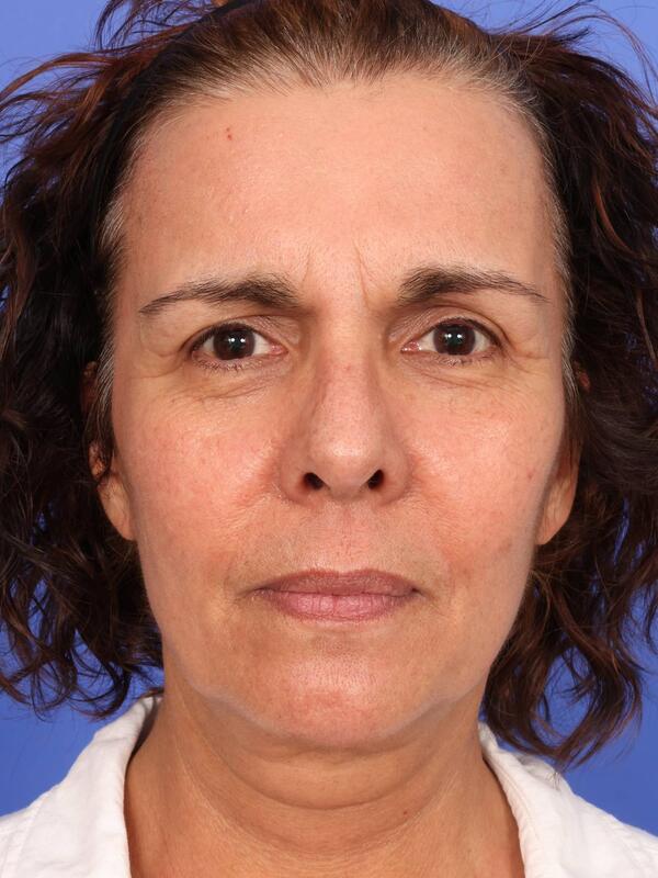 Laser Skin Resurfacing Before & After Image