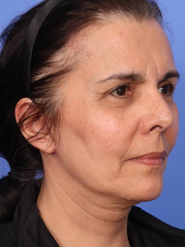 Laser Skin Resurfacing Before & After Image