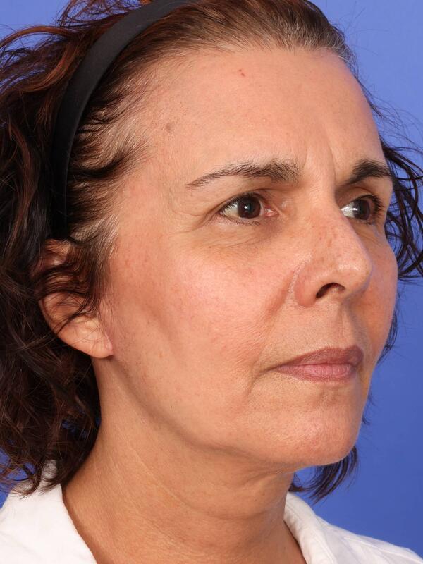 Laser Skin Resurfacing Before & After Image