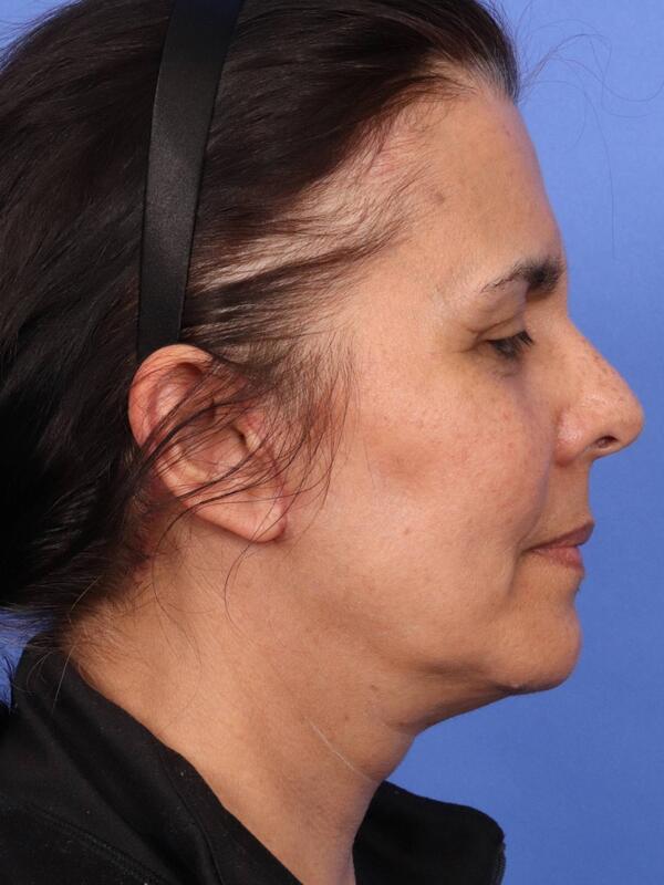 Laser Skin Resurfacing Before & After Image