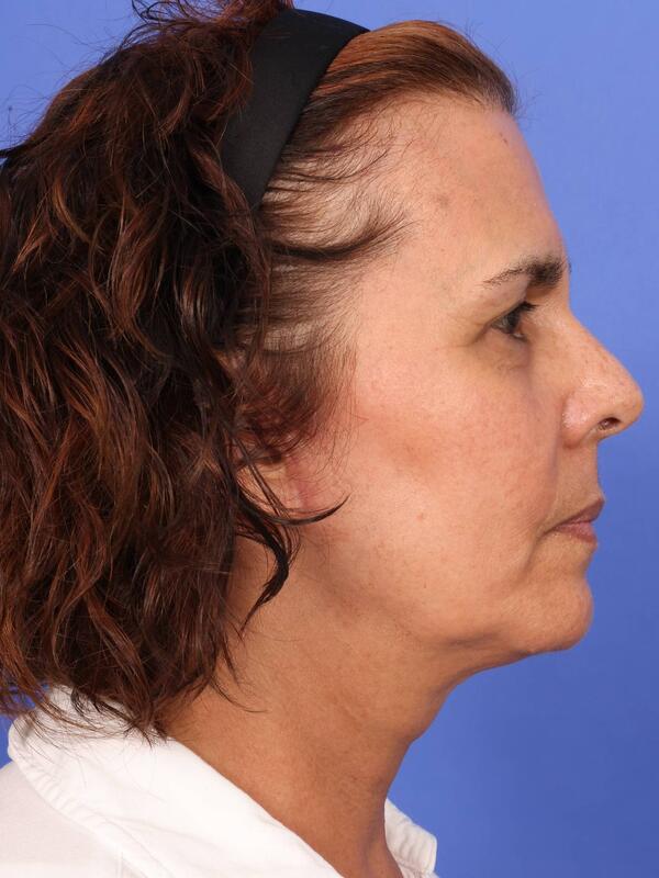 Laser Skin Resurfacing Before & After Image