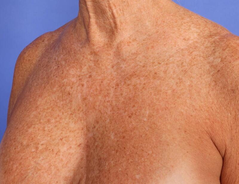 Laser Skin Resurfacing Before & After Image