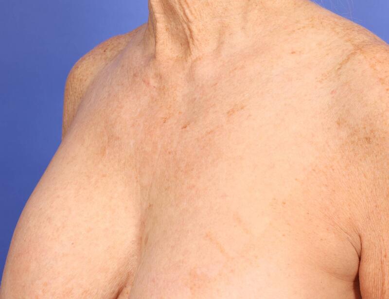 Laser Skin Resurfacing Before & After Image