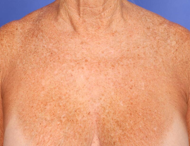 Laser Skin Resurfacing Before & After Image