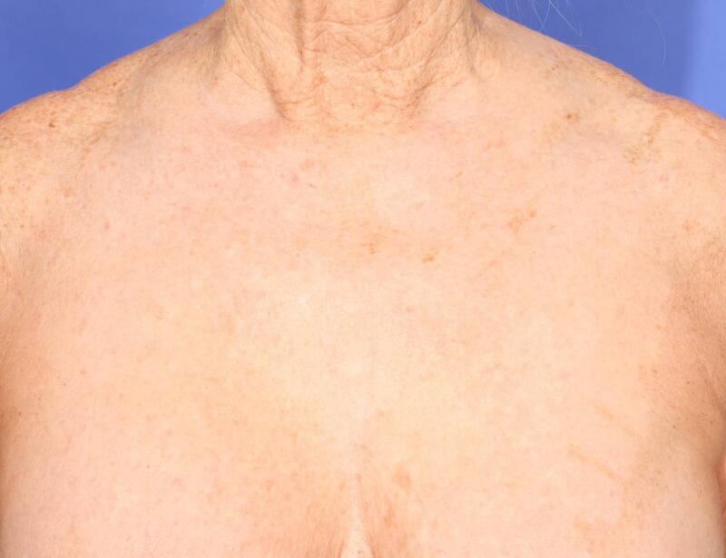 Laser Skin Resurfacing Before & After Image