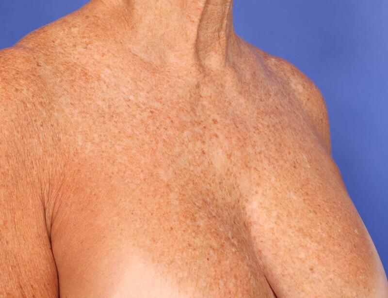 Laser Skin Resurfacing Before & After Image