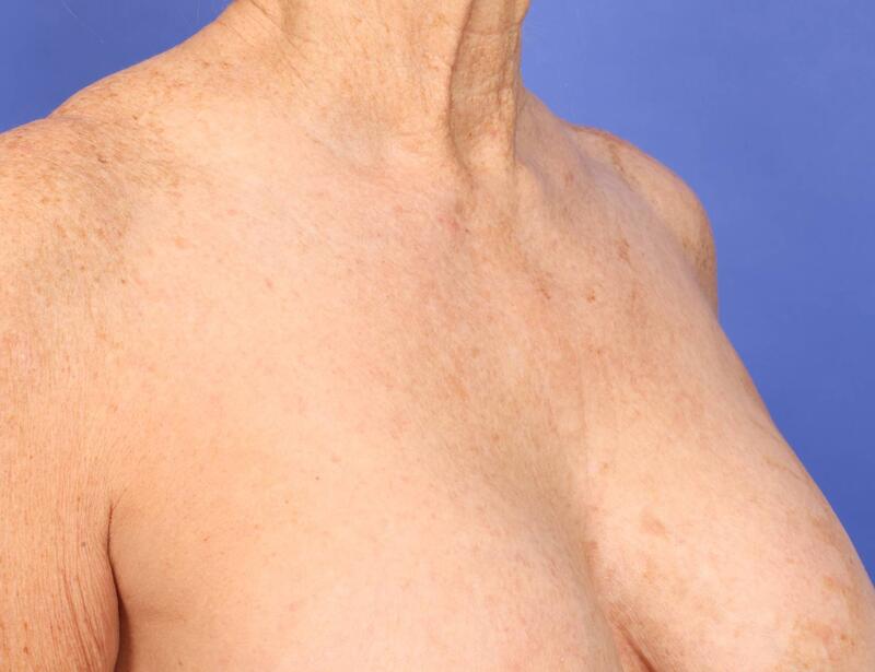 Laser Skin Resurfacing Before & After Image
