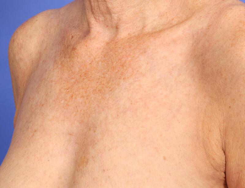 Laser Skin Resurfacing Before & After Image