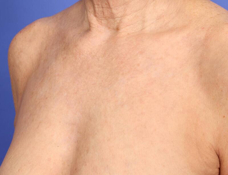 Laser Skin Resurfacing Before & After Image