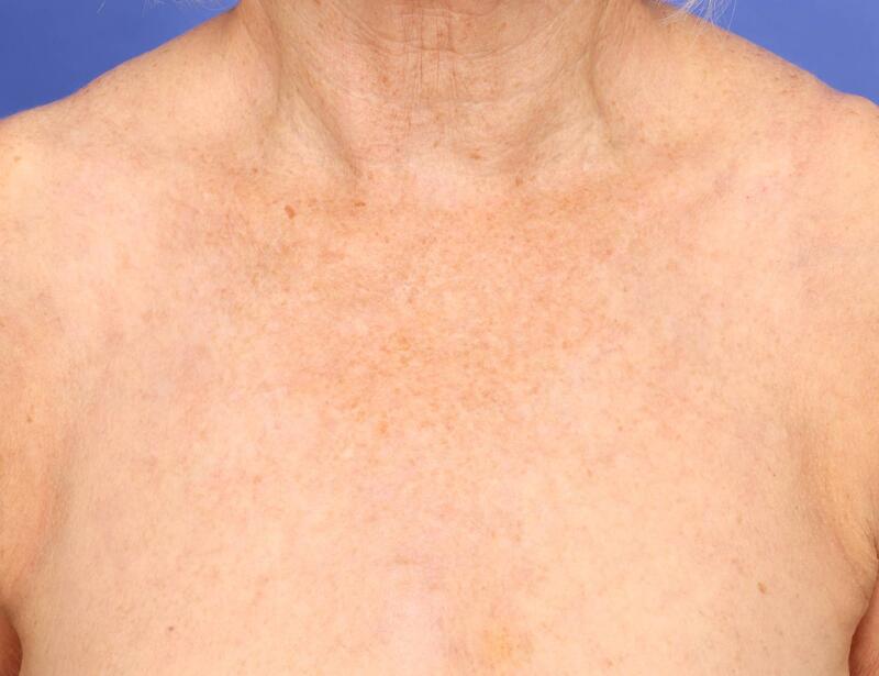 Laser Skin Resurfacing Before & After Image