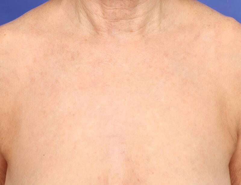 Laser Skin Resurfacing Before & After Image