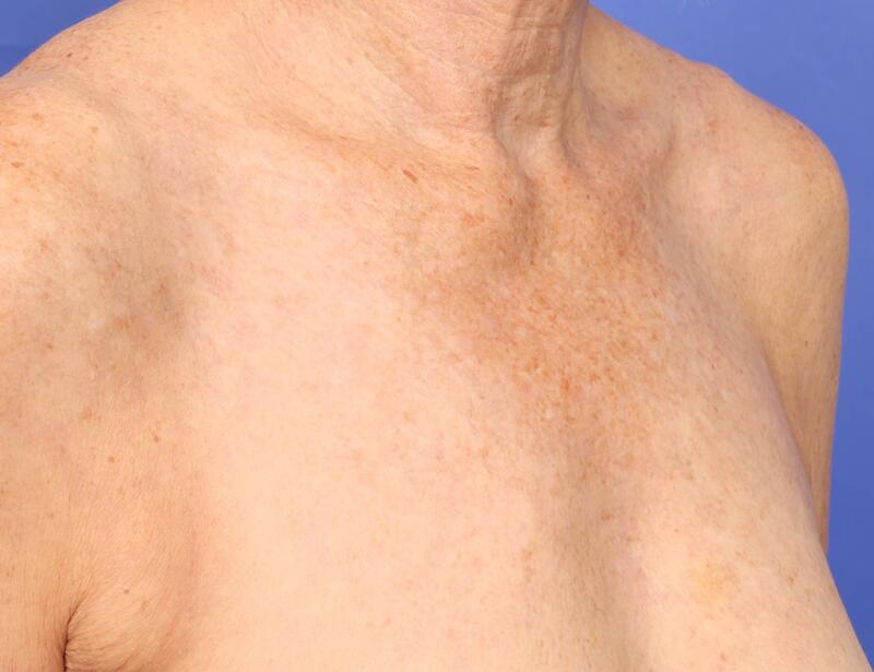 Laser Skin Resurfacing Before & After Image