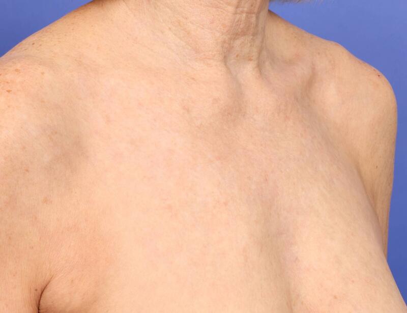 Laser Skin Resurfacing Before & After Image