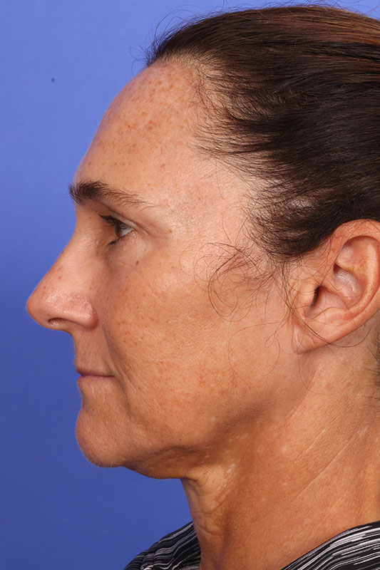 Laser Skin Resurfacing Before & After Image