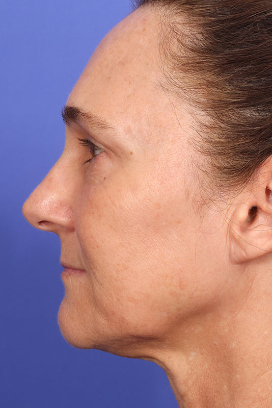 Laser Skin Resurfacing Before & After Image