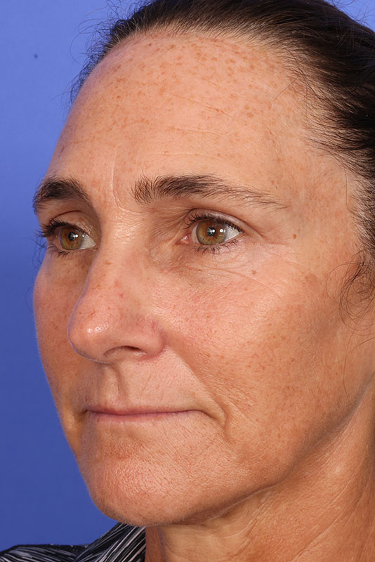 Laser Skin Resurfacing Before & After Image