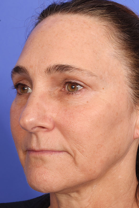 Laser Skin Resurfacing Before & After Image