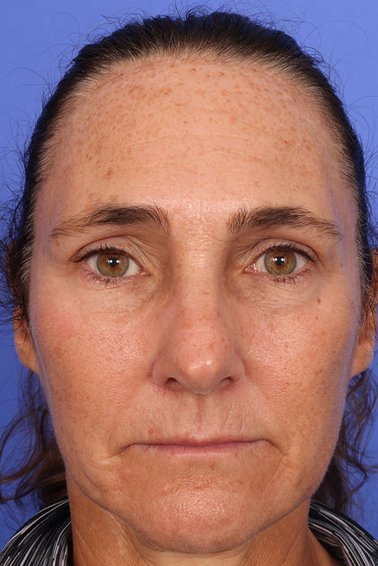 Laser Skin Resurfacing Before & After Image