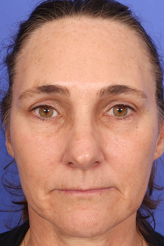 Laser Skin Resurfacing Before & After Image