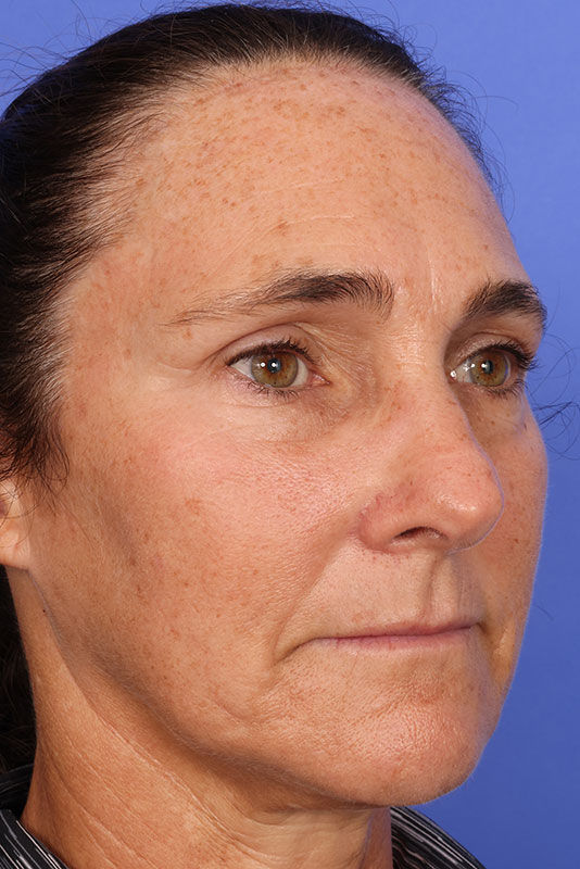 Laser Skin Resurfacing Before & After Image