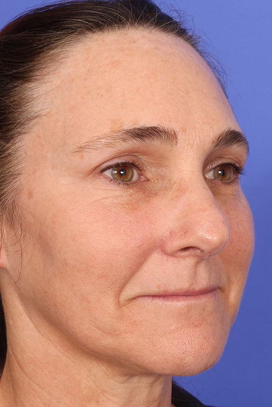 Laser Skin Resurfacing Before & After Image