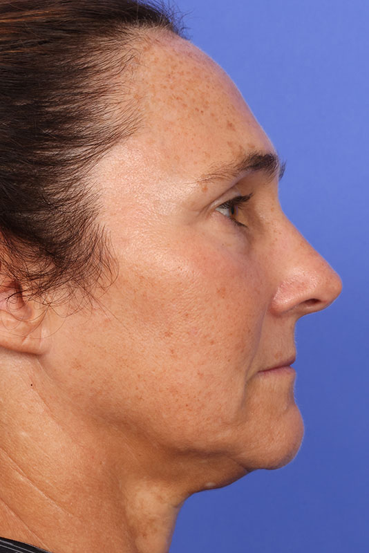 Laser Skin Resurfacing Before & After Image