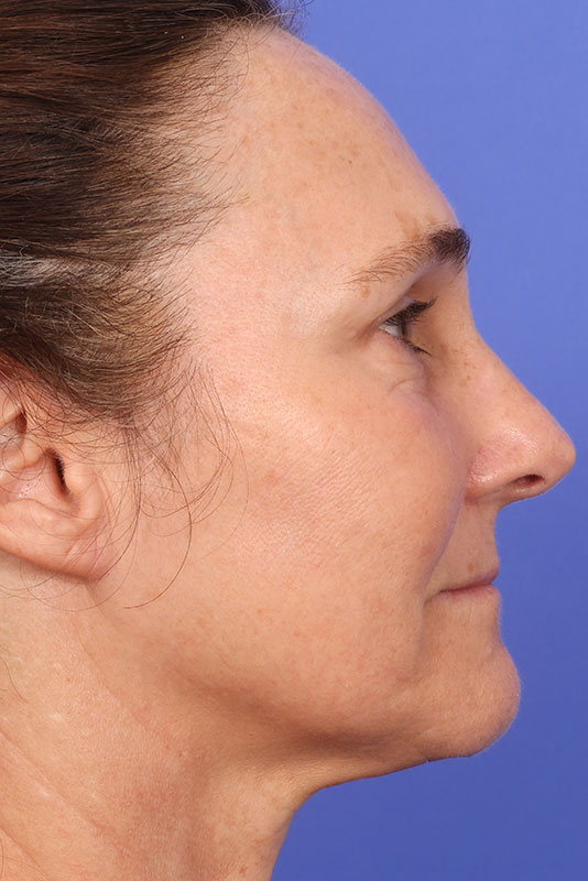 Laser Skin Resurfacing Before & After Image