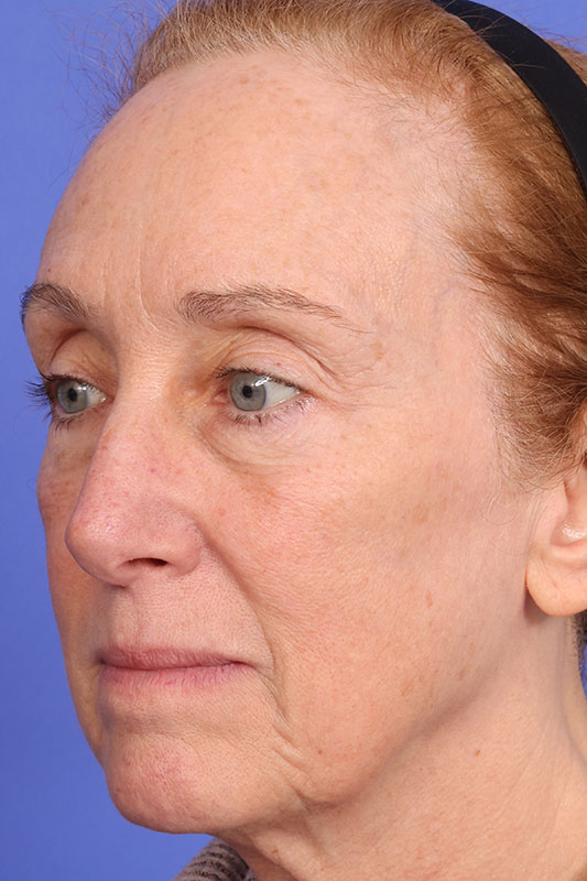 Laser Skin Resurfacing Before & After Image