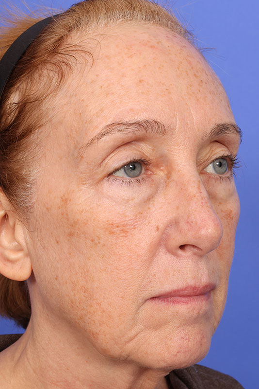 Laser Skin Resurfacing Before & After Image