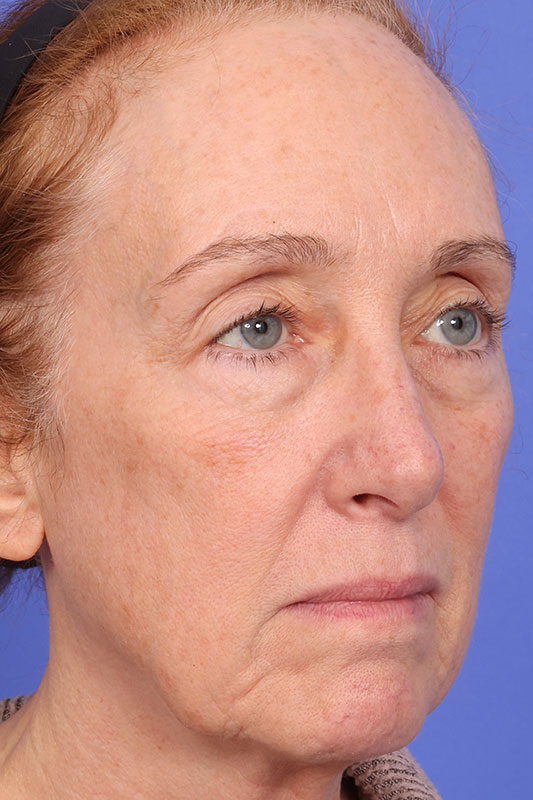 Laser Skin Resurfacing Before & After Image