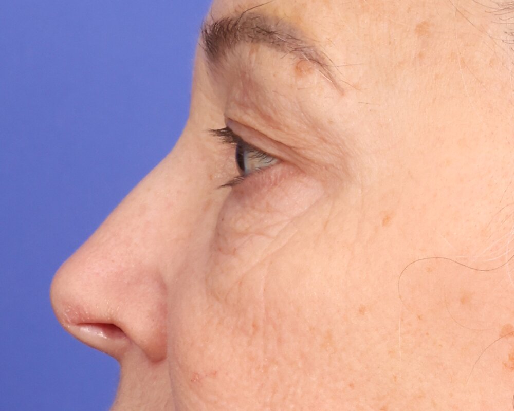 Laser Skin Resurfacing Before & After Image