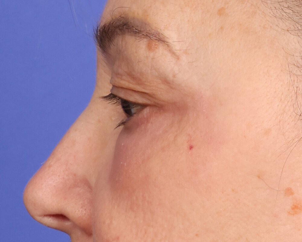 Laser Skin Resurfacing Before & After Image