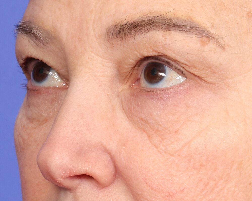 Laser Skin Resurfacing Before & After Image