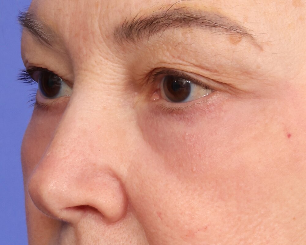 Laser Skin Resurfacing Before & After Image