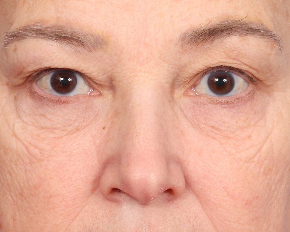 Laser Skin Resurfacing Before & After Image