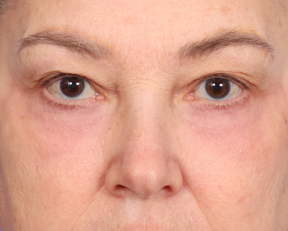 Laser Skin Resurfacing Before & After Image