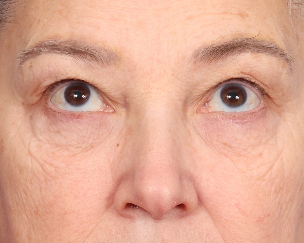Laser Skin Resurfacing Before & After Image