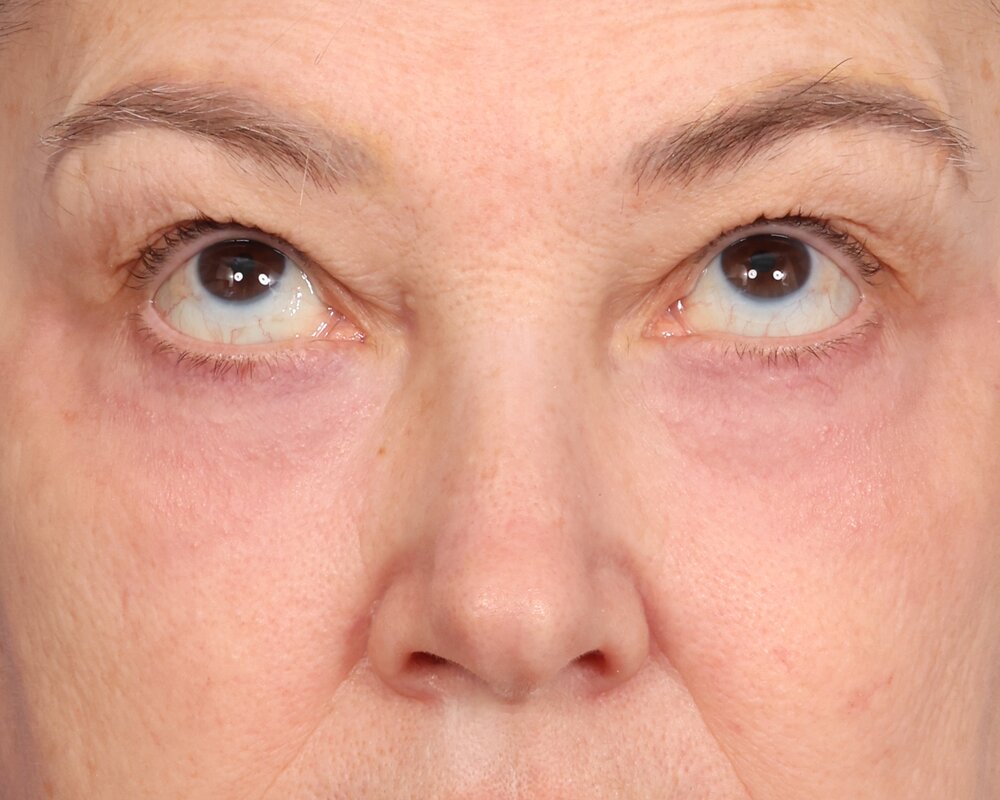 Laser Skin Resurfacing Before & After Image