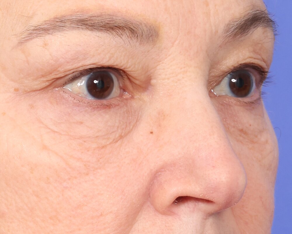 Laser Skin Resurfacing Before & After Image