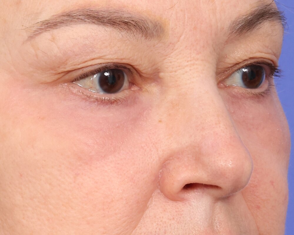 Laser Skin Resurfacing Before & After Image