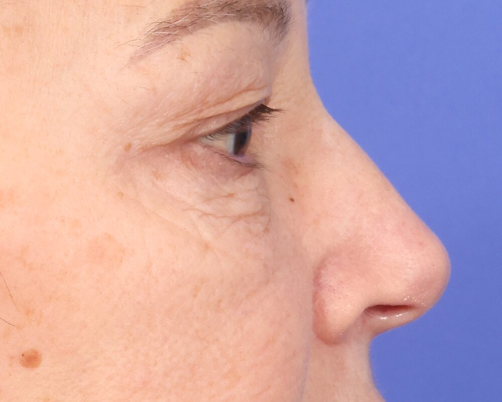 Laser Skin Resurfacing Before & After Image