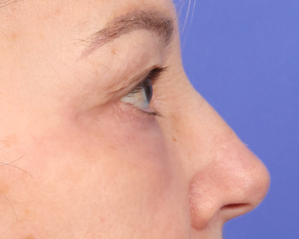 Laser Skin Resurfacing Before & After Image