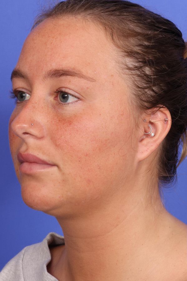 Laser Skin Resurfacing Before & After Image