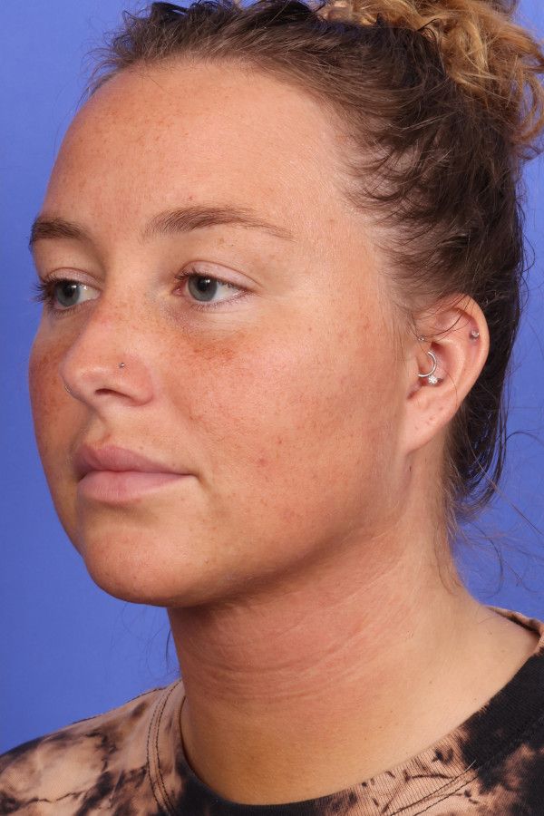 Laser Skin Resurfacing Before & After Image