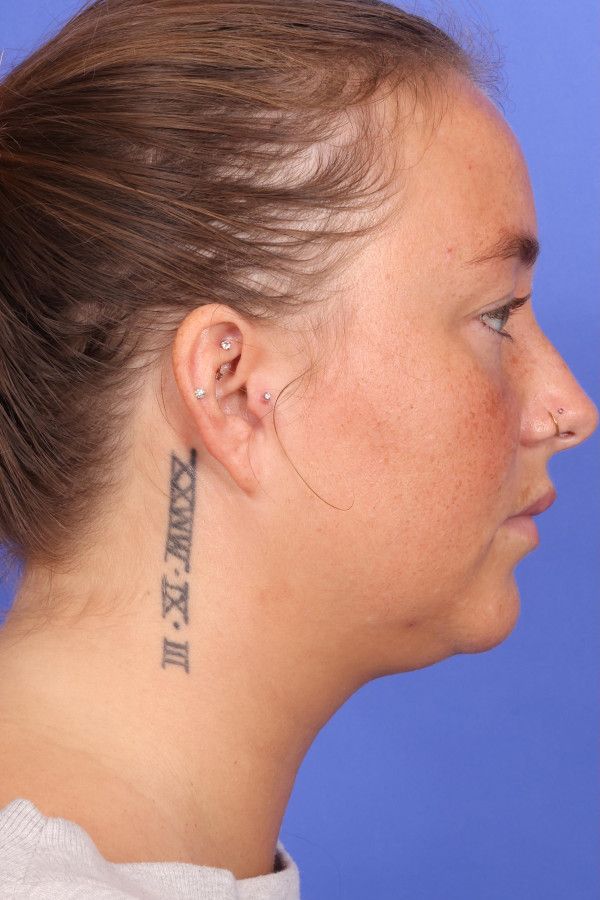 Laser Skin Resurfacing Before & After Image