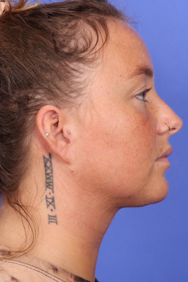 Laser Skin Resurfacing Before & After Image