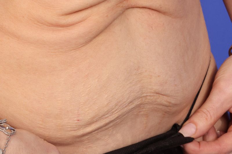 RF Microneedling Before & After Image