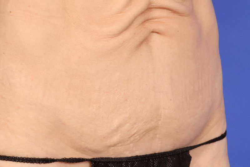 RF Microneedling Before & After Image